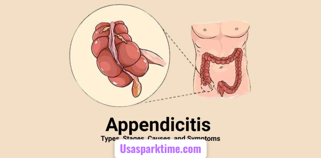 4 Stages of Appendicitis